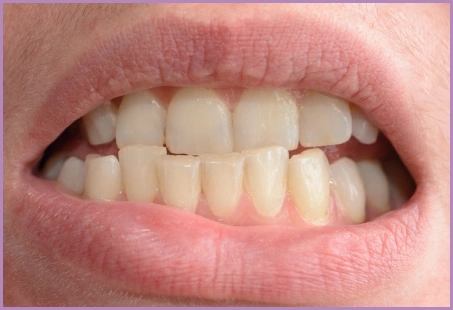 Crooked Bottom teeth