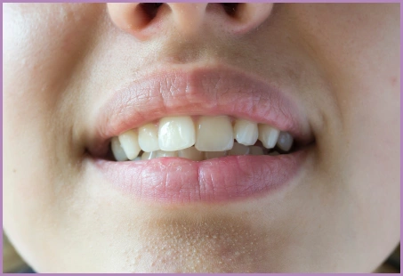 Crooked Front teeth