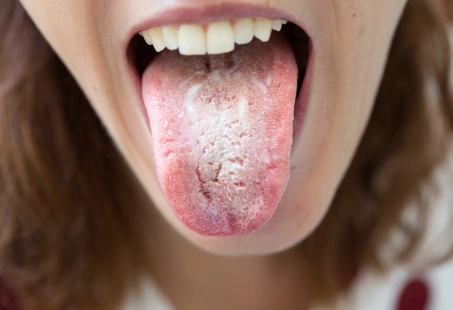 WWhite Tongue