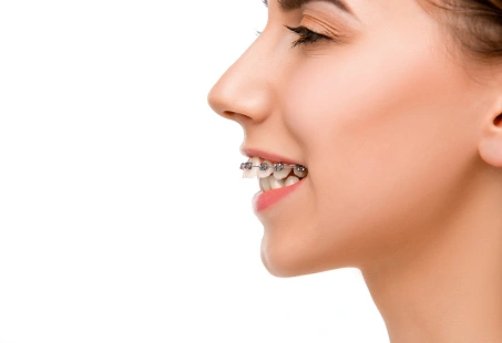 Overjet vs Overbite: Causes & Treatments