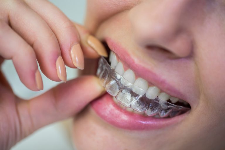 woman wearing orthodontic silicone invisible braces 768x512 1