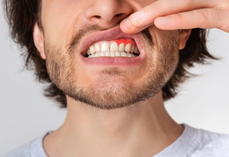 Tooth Abscess Stages: How It Starts and How To Prevent & Treat It 