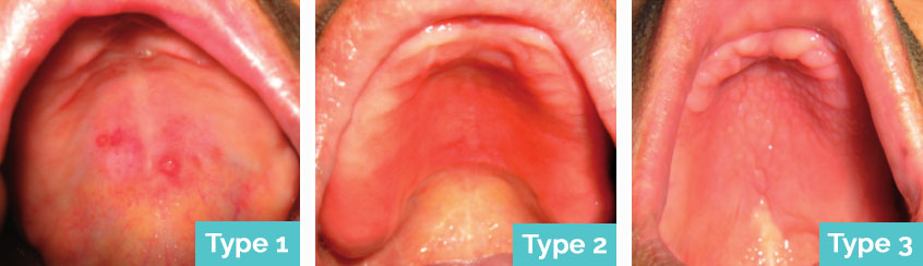 denture stomatitis
