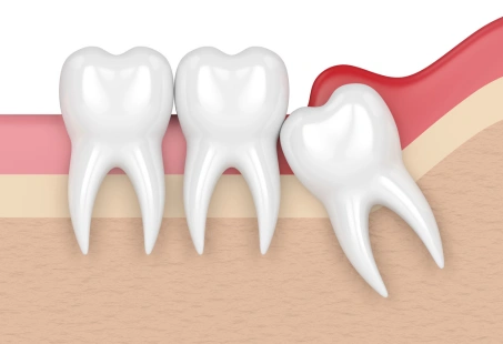 Pericoronitis: What Is It, Symptoms, Risk Factors & Treatments