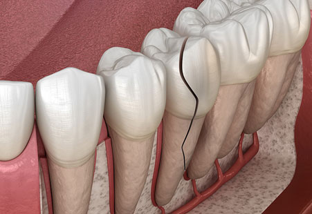 Teeth Craze Lines: Causes, Treatments & 6 Ways To Prevent Them