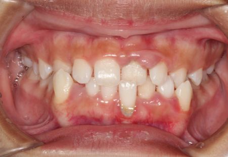 Gingival Hyperplasia: Causes, Symptoms & 4 Ways To Get Rid Of It  