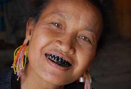 Black Teeth: Causes, Treatment & Prevention