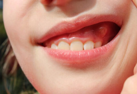 Gum boil: Causes, Symptoms & 4 Ways To Get Rid Of It