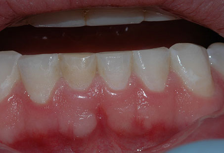 Root Resorption: What It Is, Symptoms & Treatments