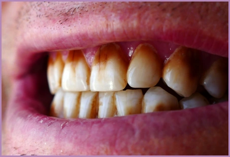 Is Vaping Bad For Your Teeth? 9 Reasons to Quit