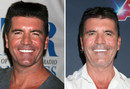 Simon Cowell smile makeover
