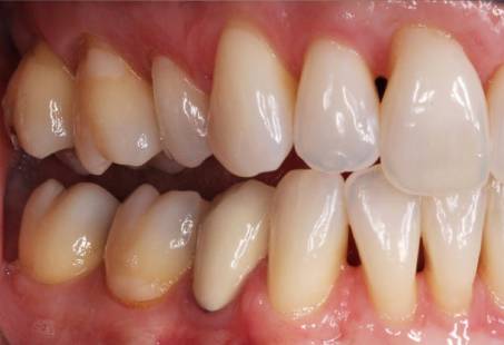 black triangle teeth