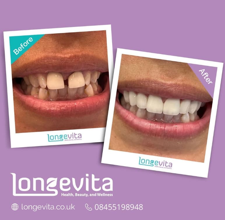 upper jaw teeth crown and lower teeth whitened