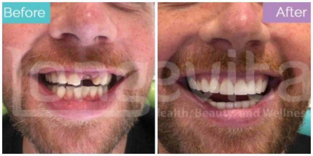 dental crown before after