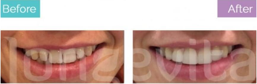 composite bonding before after