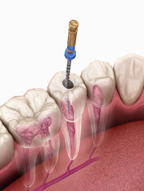 canal treatment