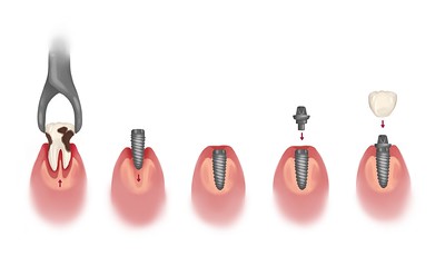 Dental Implant Stages