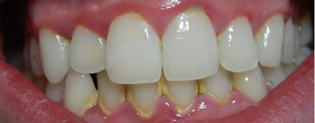 Gingivitis