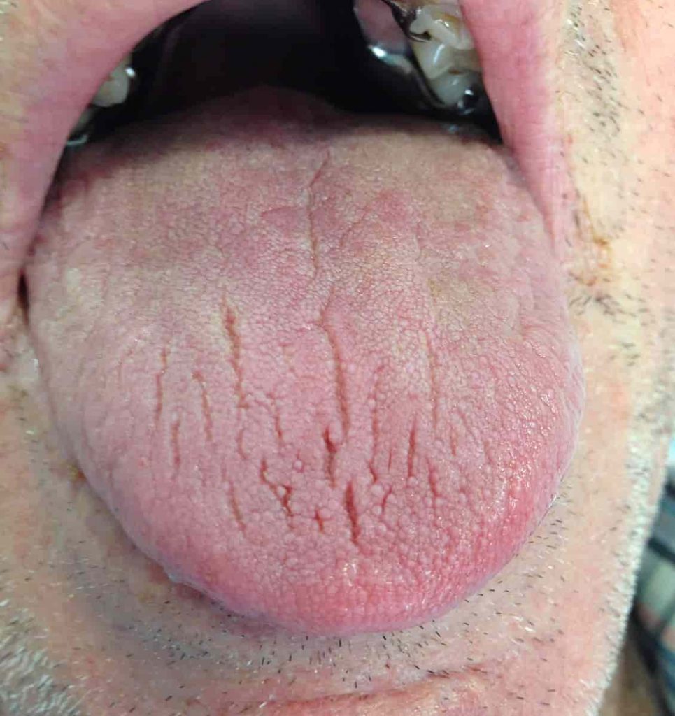dry mouth