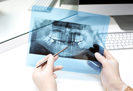 same day dental implants