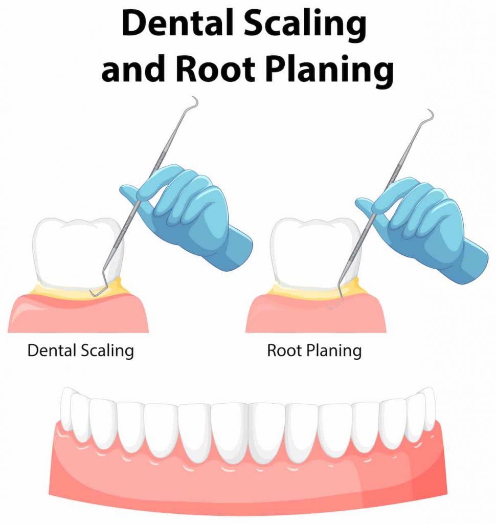 scaling and root planing
