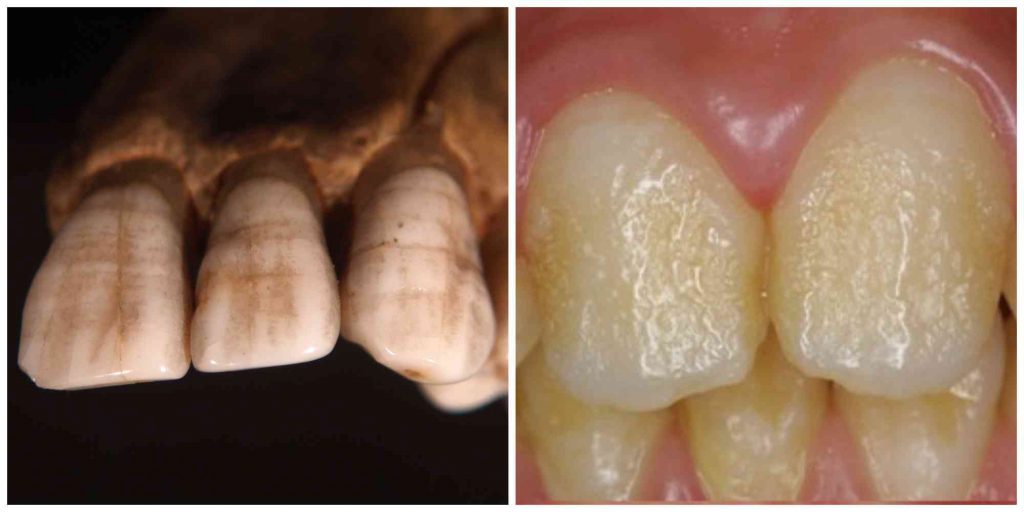 Linear and pitted enamel hypoplasia