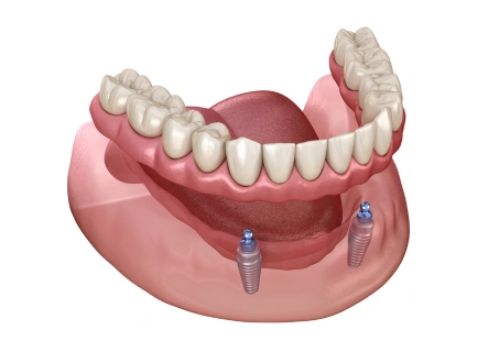 Mini VS traditional dental implants