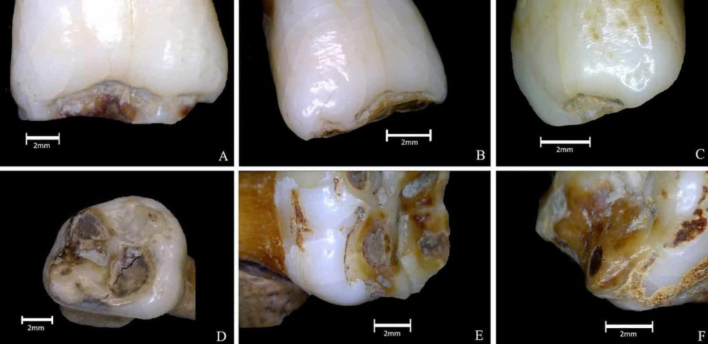 plane form enamel hypoplasia