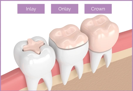 Inlay onlay crown