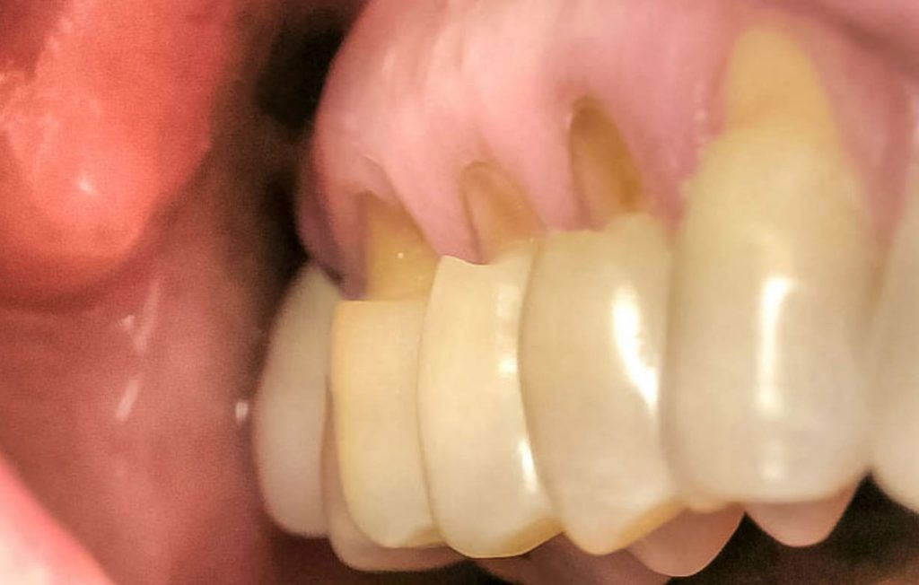 Abfraction dents on teeth
