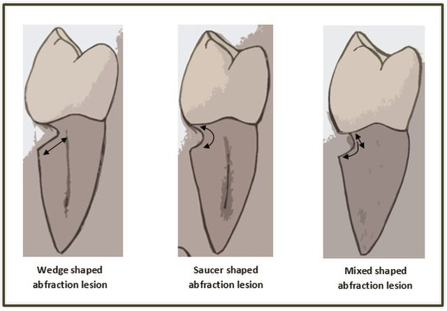 Abfraction lesions