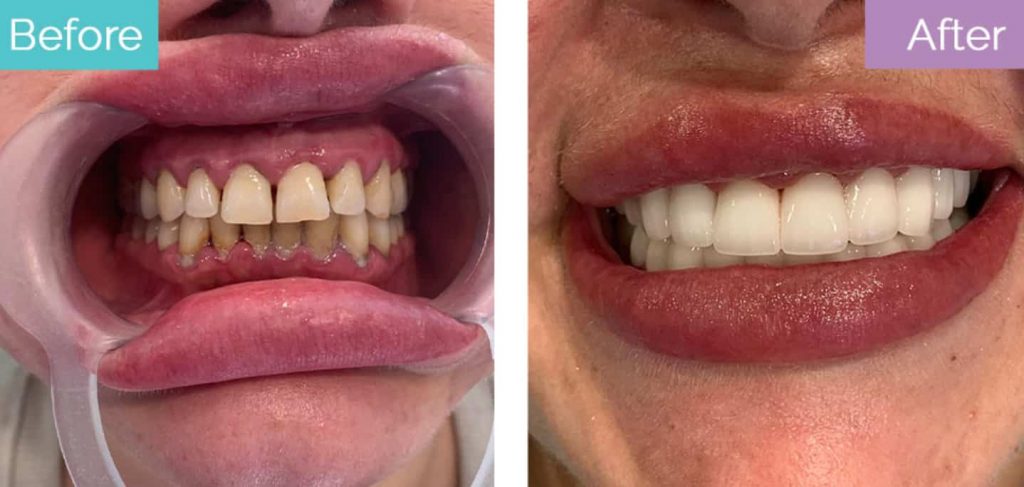 Dental crown result