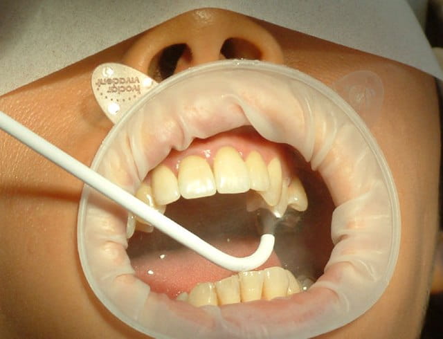 Optical scanning for CEREC crown