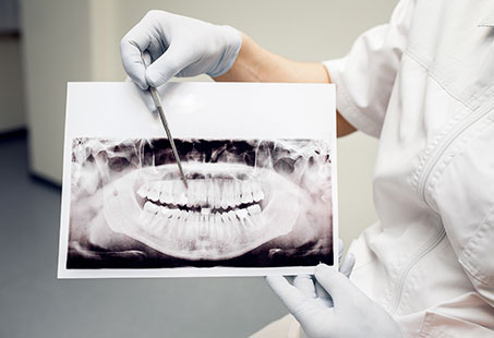 abfraction lesions
