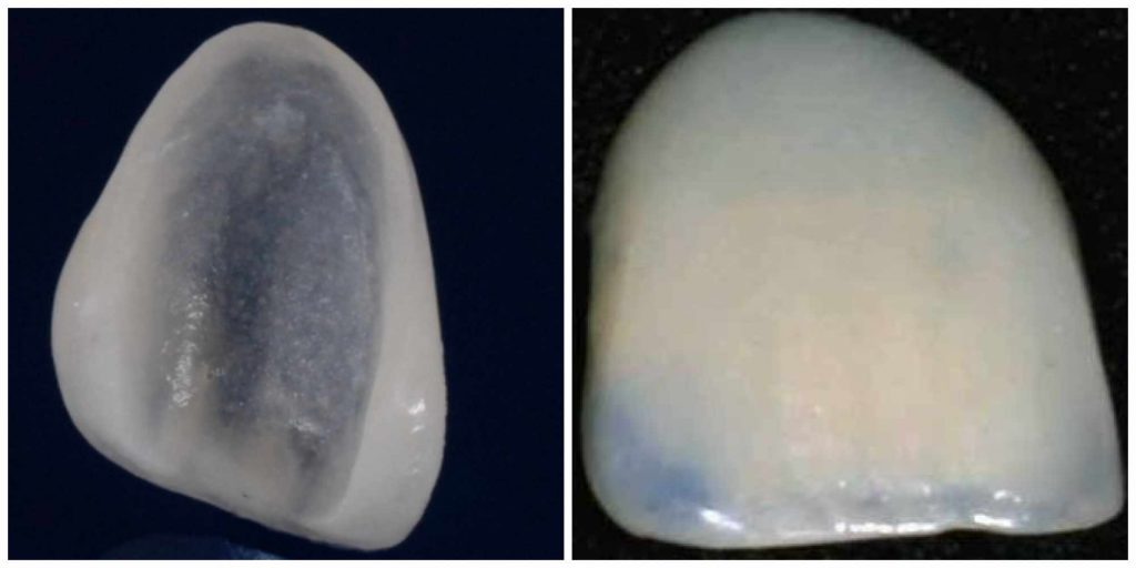no prep vs traditional veneers