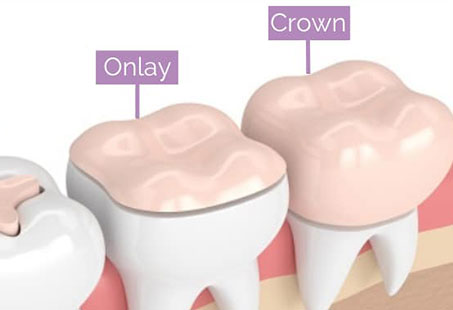 onlay vs crown