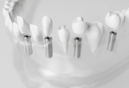 3 on 6 implants