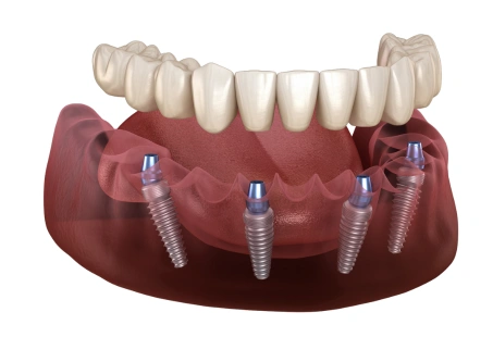 All on 4 implants on the lower jaw