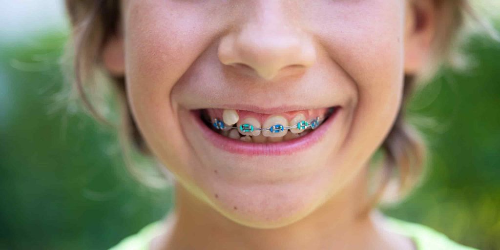 Braces for crooked teeth