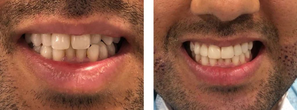 Composite bonding for crooked teeth