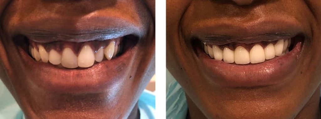 Crowns for crooked teeth
