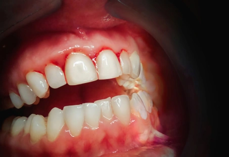 What Is Gum Disease?