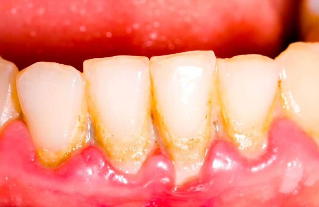 Teeth plaque