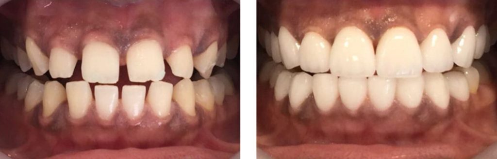 Veneers for crooked teeth