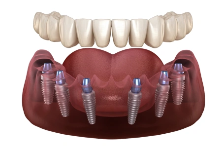 all on 6 implants 1