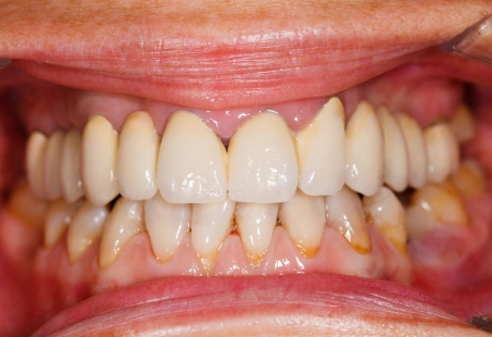 dental plaque