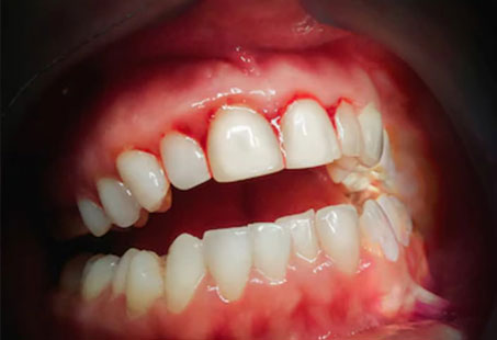 Bleeding gums