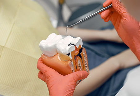 root canal infection