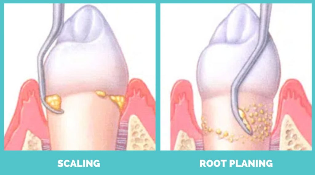 scaling vs root planing
