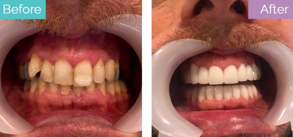 dental crown before after
